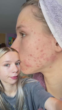 Meltdown Acne Oil Treatment