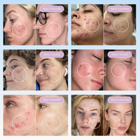 The Ultimate Meltdown Bundle for Acne