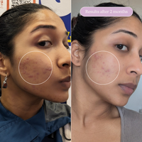 Hormonal Acne Kit