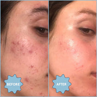 Meltdown Acne Oil