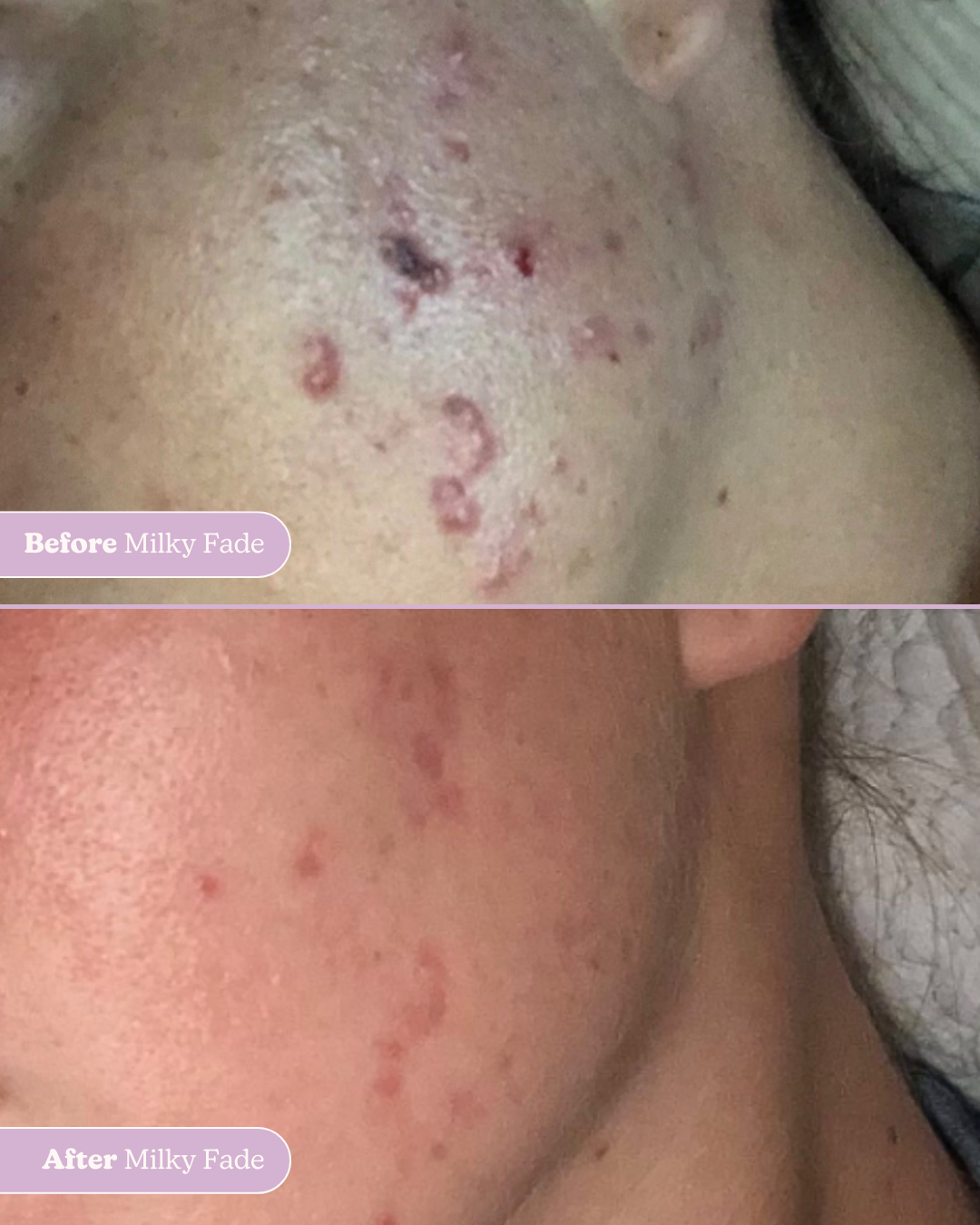 Before and after image of acne scars and dark spots on the cheek improving after using Milky Fade Spot & Scar Fade Serum.