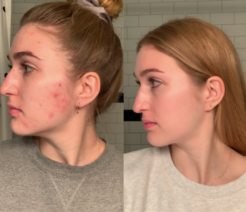 Before and after Milky Fade Spot and Scar Serum treatment results showing clear skin transformation