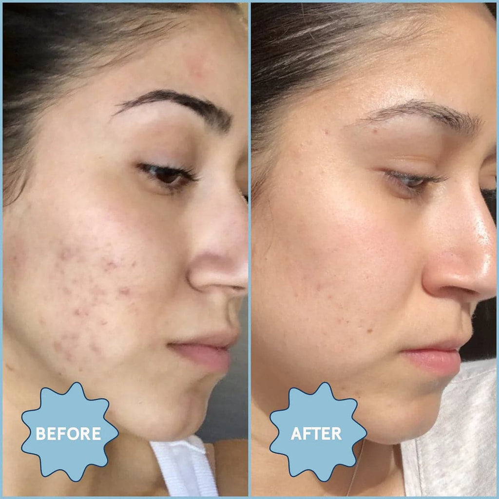 Clear Skin Kit: Acne Essentials