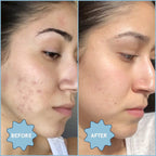 Clear Skin Kit: Acne Essentials