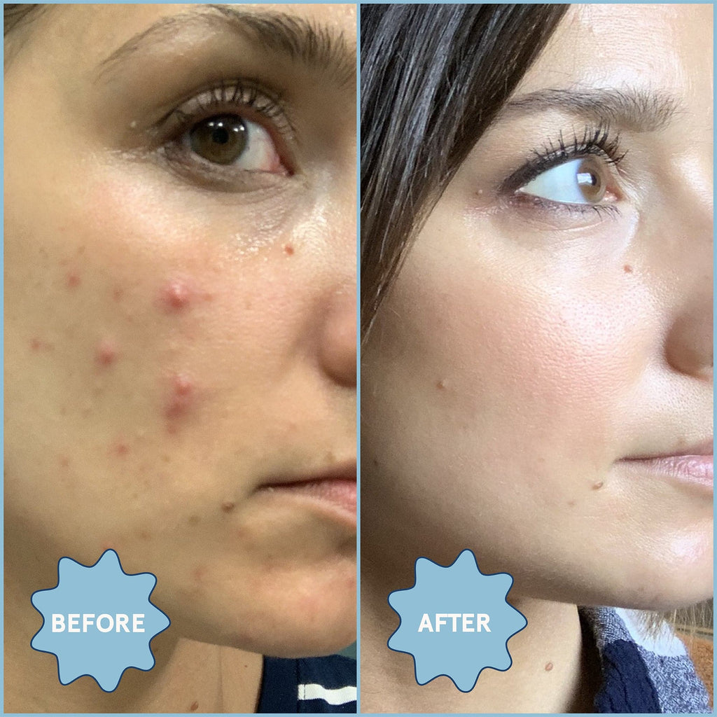 Clear Skin Kit: Acne Essentials