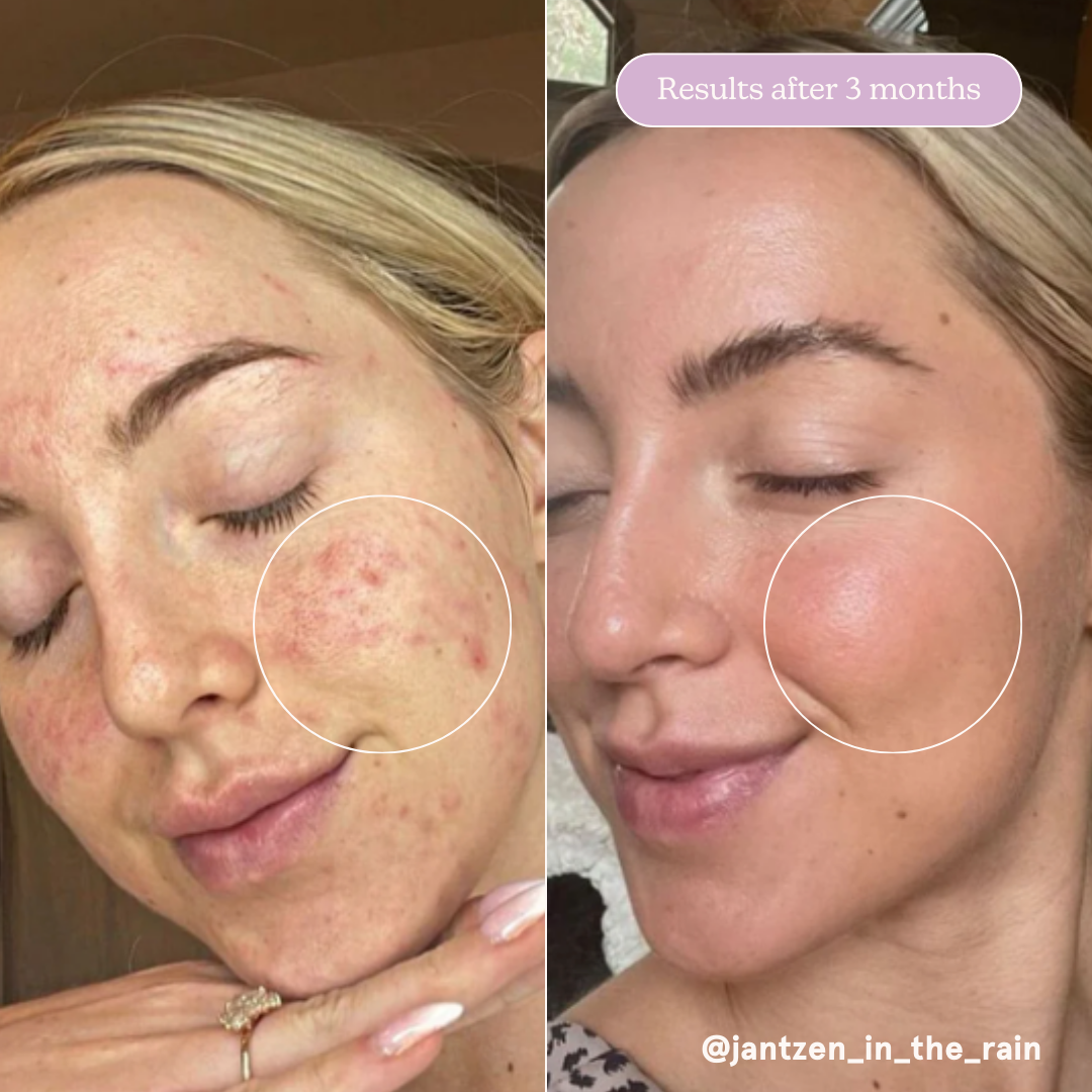 Meltdown Acne Oil Treatment