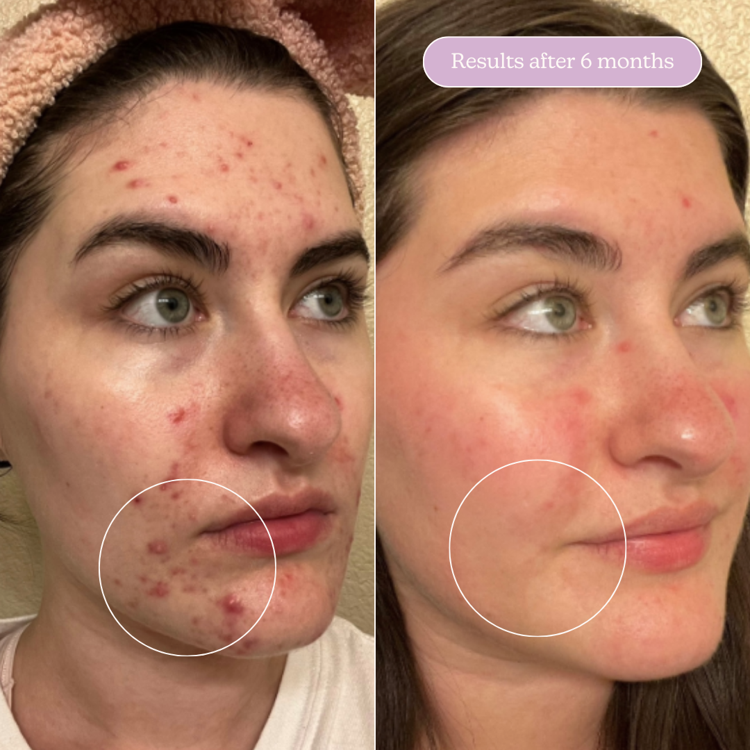 Acne Treat & Fade Bundle