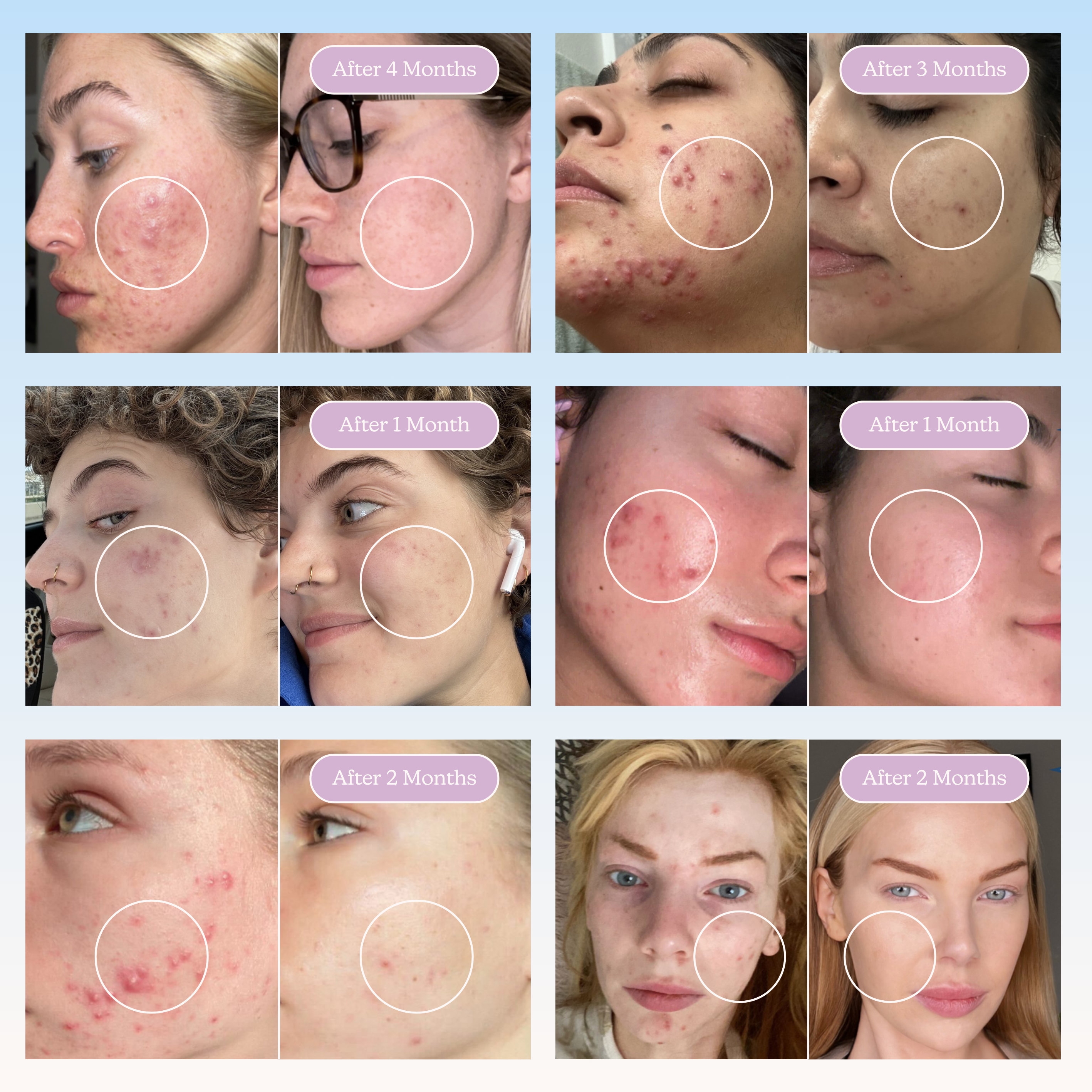 The Ultimate Acne Routine
